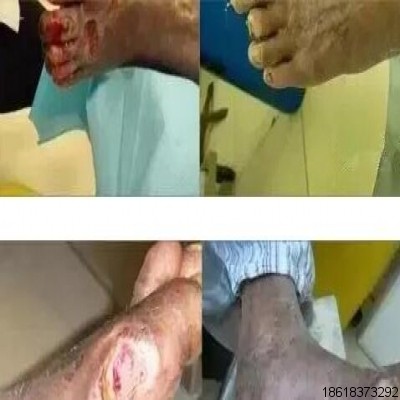 創面修復：三氧治療糖尿病足的優勢